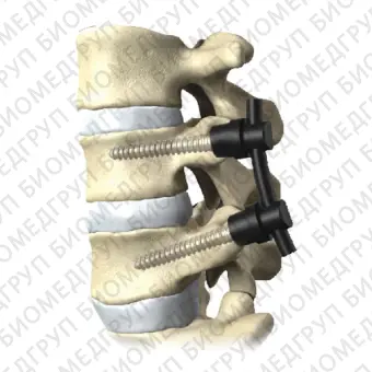 Система остеосинтеза для грудопоясничнокрестцовой зоны CarboClear