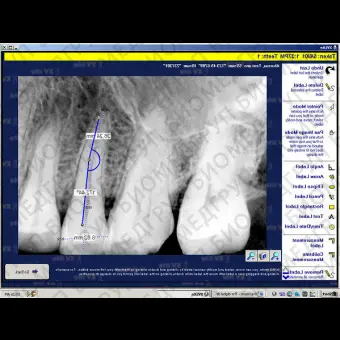 Программное обеспечение для обработки снимков зубов XrayVision