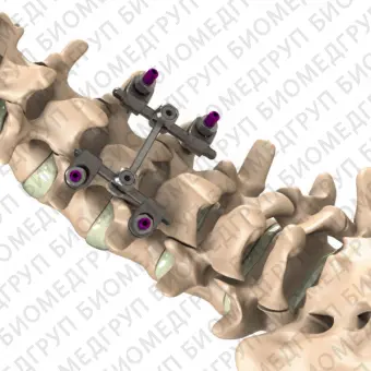 Система остеосинтеза для поясничной зоны I SHAPED