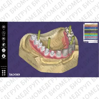 Exocad Implant Module  модуль для создания имплантов