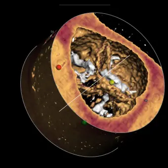 Медицинское программное обеспечение 3mensio Aortic valve