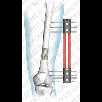 Внешний фиксатор большеберцовая кость Cromus