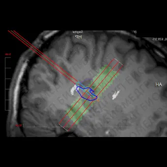 Программное обеспечение для медицинских снимков NeuroBlate  SoftwareTM NeuroBlate 