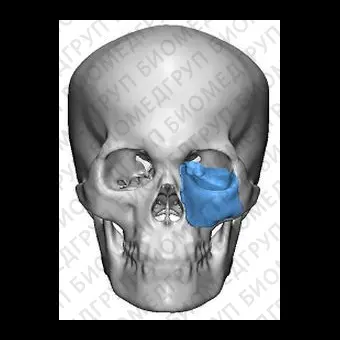 Имплантат параорбитальной области на заказ TnR PSI