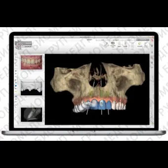 Программное обеспечение для стоматологической имплантологии NobelClinician