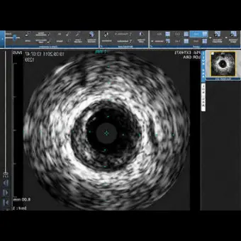 Программное обеспечение для исследования сосудов CAAS IVUS OCT