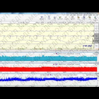 Монитор пациента для ЭЭГ NEUROMONITOR