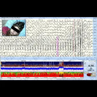 Монитор пациента RESP ENCEPHALANVIDEO