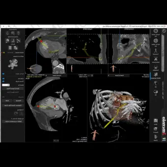 Медицинское программное обеспечение 3mensio Aortic valve