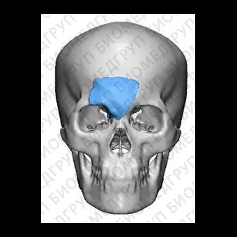 Имплантат параорбитальной области на заказ TnR PSI