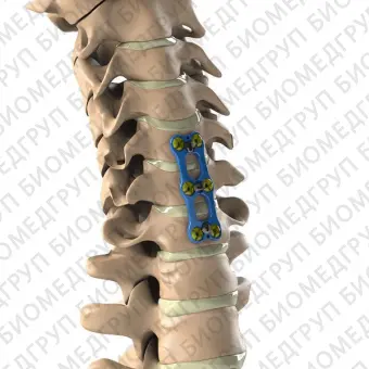 Шейная костная пластина для артродеза  Aditus T6Al4V ELI