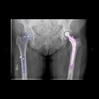 Программное обеспечение для хирургии тазобедренного сустава Hip Arthroplasty