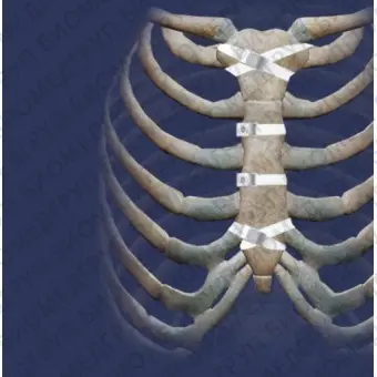 Ортопедическая проволока для закрытия груди Ortholox UHMWPE