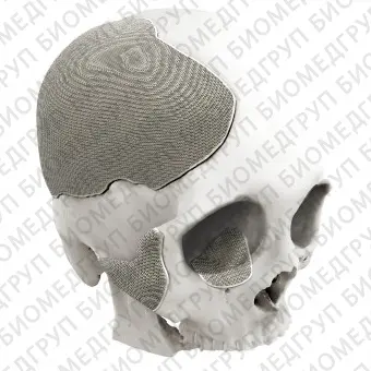 Черепной имплантат на заказ 3D Titanium