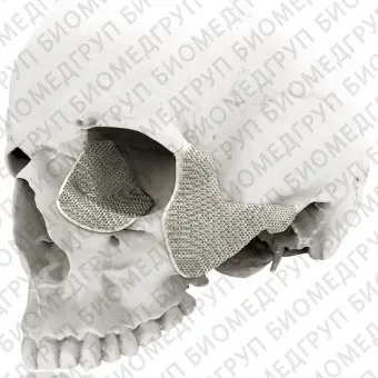 Черепной имплантат на заказ 3D Titanium