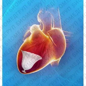 Устройство для лечения недостаточности митрального клапана левый желудочек сердца Parachute