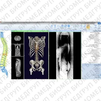 Программное обеспечение для МРТ mediCAD 3D Spine