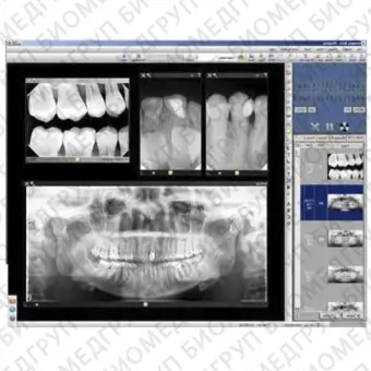 Программное обеспечение для обработки снимков зубов PROGENY