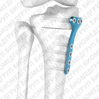 Костная пластина для остеотомии большеберцовая кость FlexitSystem