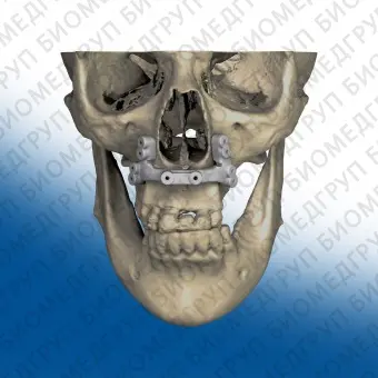 Материалы для челюстнолицевого восстановления  Nylon12