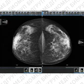 Программное обеспечение для маммографии Suitestensa MG