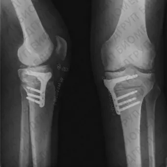 Костная пластина для остеотомии большеберцовая кость FlexitSystem