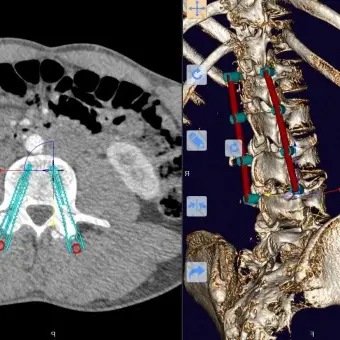 Программное обеспечение для МРТ mediCAD 3D Spine