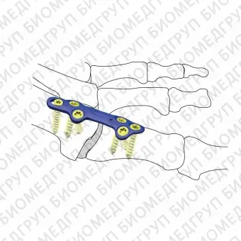 Костная пластина для артродеза ступня HJFoot VALOC 02