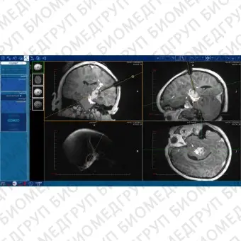 Программное обеспечение для медицинских снимков NeuroBlate  SoftwareTM NeuroBlate 