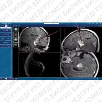 Программное обеспечение для медицинских снимков NeuroBlate  SoftwareTM NeuroBlate 