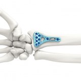 Компрессионная костная пластина лучевая кость ARIX 2.5