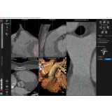 Анатомическое программное обеспечение 3mensio Pulmonary valve