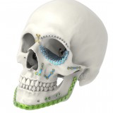 Компрессионная костная пластина для челюстно-лицевого восстановления LeForte 2.4